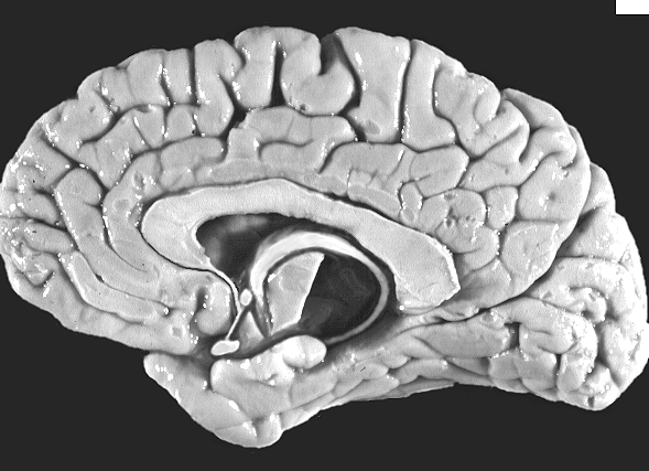 Right Hemisphere,Medial View 2.gif