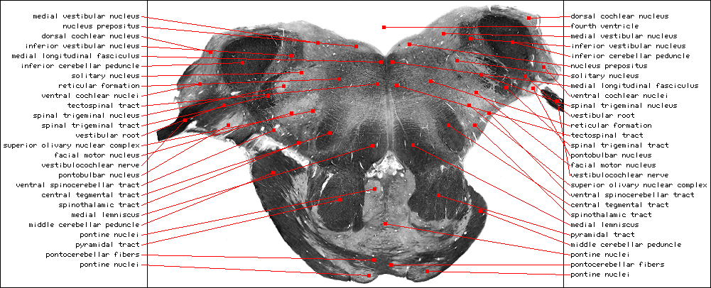 Medulla, Vestibolocochlear Nerve L.gif