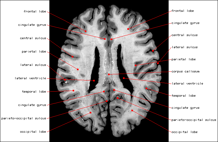Lateral Ventricles L.gif